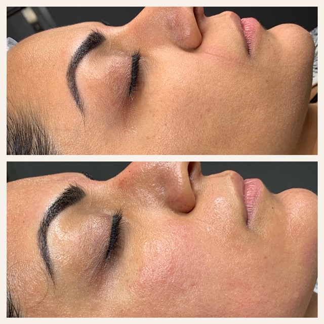Microneedling straight after treatment-removal of smile lines
